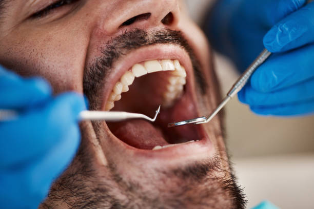Best Emergency Wisdom Teeth Removal in Marysville, OH